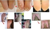 Мягкие Пяточки - пилинг-носочки для здоровья ваших ног
